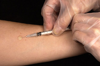 1_Mantoux_tuberculin_skin_test.jpg