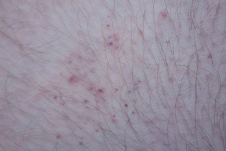 Bedbug_bites_on_human_thigh_2.jpg