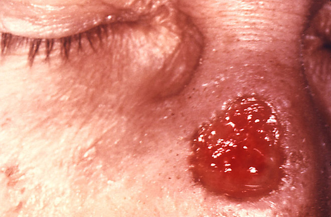 Gumma_of_nose_due_to_a_long_standing_tertiary_syphilitic_Treponema_pallidum_infection_1.jpg